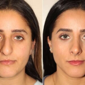Nose Correction