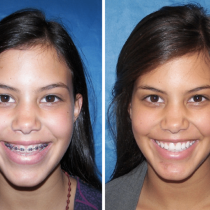 Jaw Correction