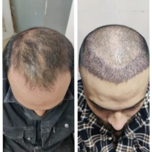 Hair Transplant Surgeries