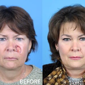 Facial Reconstruction