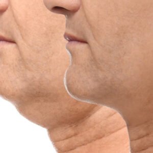 Chin Correction