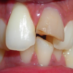 Pre-Prosthetic Surgeries