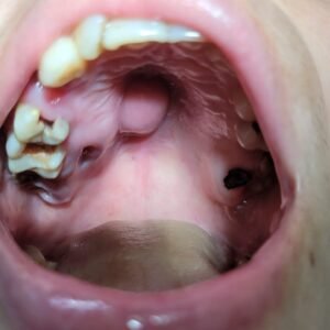 Maxillofacial Surgeries