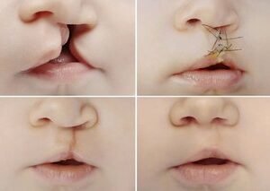Cleft Lip and Palate